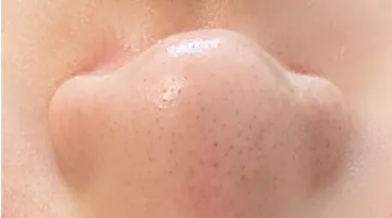 鼻のアフター画像