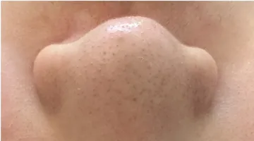 鼻のビフォー画像